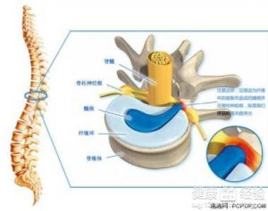 腰椎间盘突出最新疗法，探索前沿技术与治疗希望